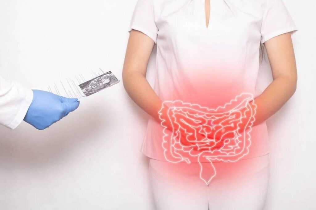 imagem demonstrando inflamação no intestino, disbiose intestinal