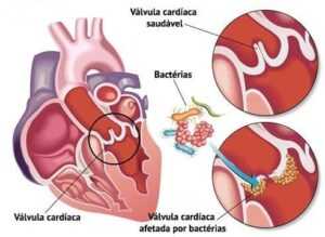 imagem ilustrativa mostrando lesão de válvula cardíaca decorrente do processo infeccioso da Endocardite.