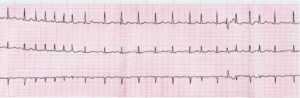 imagem de exame de eletrocardiograma demonstrando fibrilação atrial