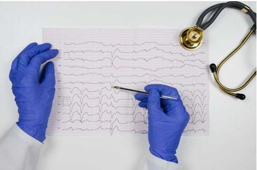 imagem de eletrocardiograma demonstrando uma extrassístole