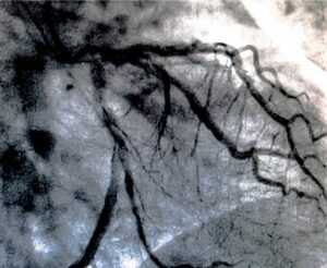 imagem de cateterismo cardíaco realizado para angioplastia coronariana em paciente internado por infarto