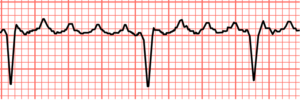 imagem de um exame de eletrocardiograma mostrando a ocorrência de flutter atrial